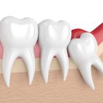 Everything you need to know about wisdom tooth extraction singapore