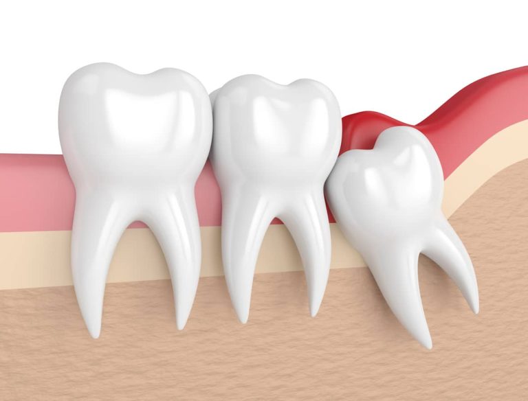 Everything you need to know about wisdom tooth extraction singapore