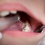 Clear Braces in Clapham: A Discreet Solution for Straightening Teeth