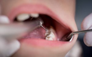 Clear Braces in Clapham: A Discreet Solution for Straightening Teeth